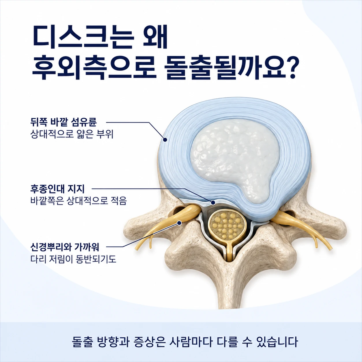 허리디스크가 후외측으로 돌출되기 쉬운 구조적 이유